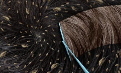 O que significa sonhar com piolho